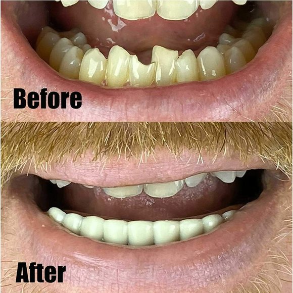 Instant Smile Natural Shaded Handmade Lower Veneer Temporary Teeth - Picture 4 of 6